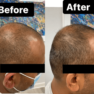 PRP hair restoration before and after results