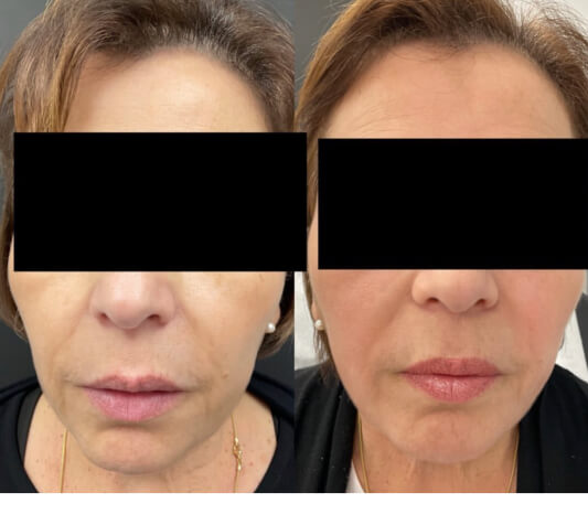 RF microneedling before and after results