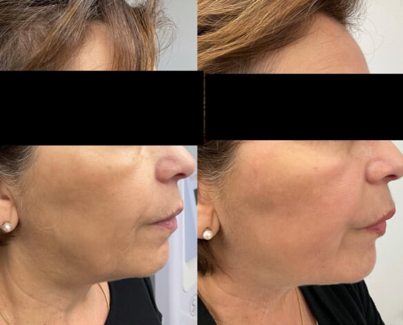 RF microneedling before and after results