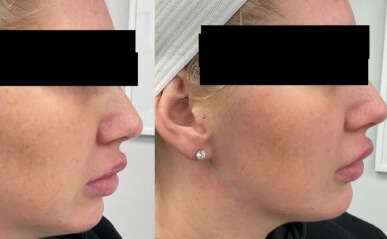 ZenLifeMD before and after results