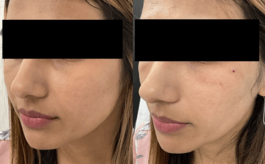 dermal filler before and after results