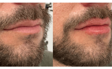 dermal filler before and after results